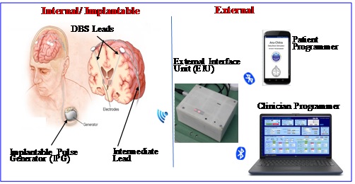 Fig. 2: DBS system components