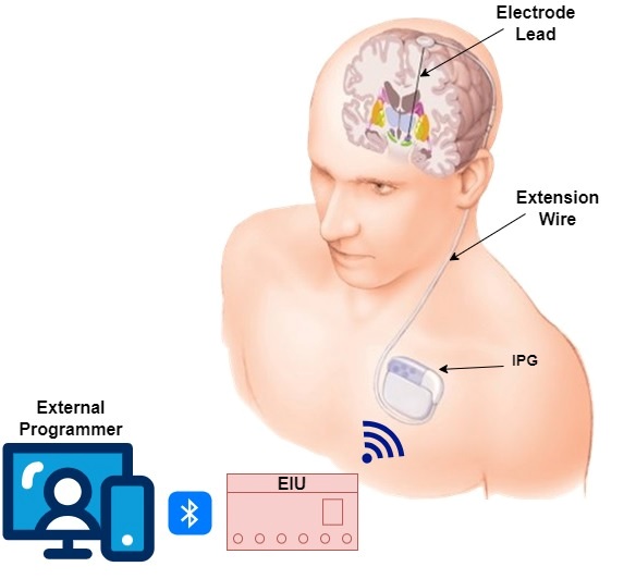 Fig. 1: Deep Brain Stimulation (DBS)